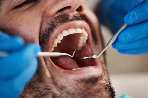 Best Emergency Dentist for Knocked-Out Tooth in Dundee, OR